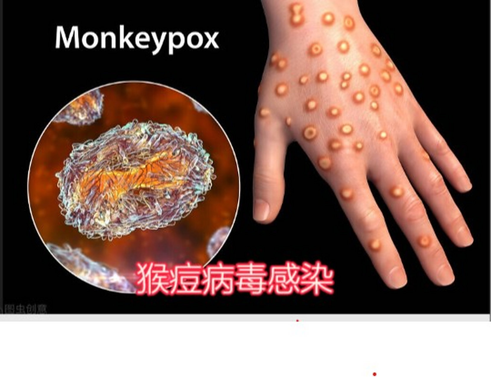 我国猴痘病毒患者都是男性,且为男男性行为群体!