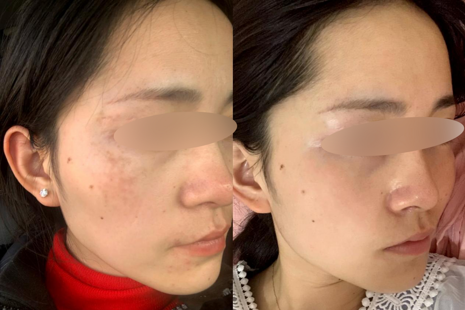 长斑时间长,肾虚型黄褐斑  黄褐斑这个时间是比较长了,面积大而且颜色