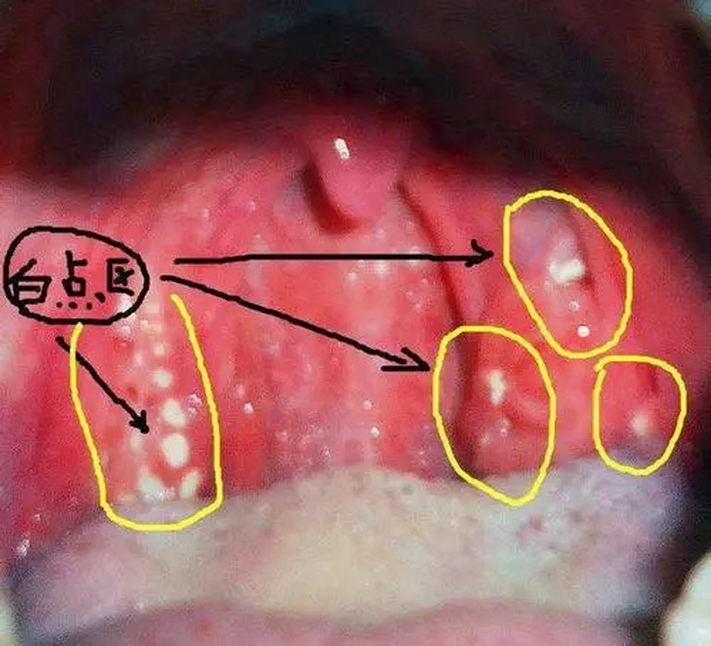 喉咙白斑是什么病图片