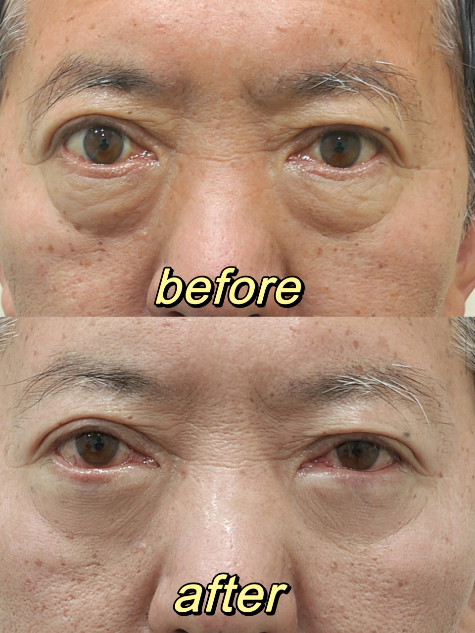 【不开刀祛眼袋】 术后即刻对比 长期作息不规律还有一些坏习惯比如