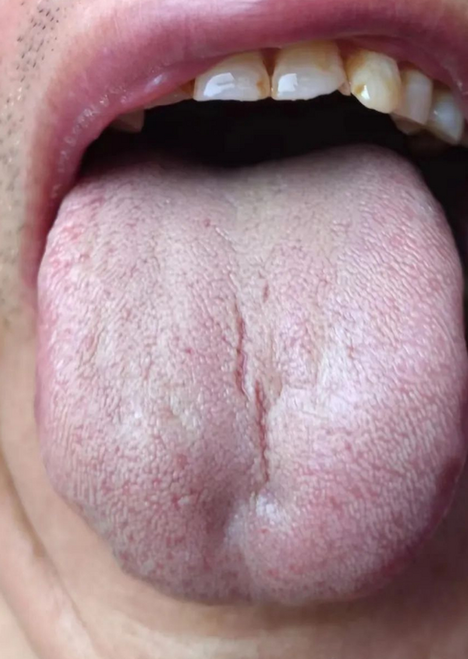 这个舌象相对比较简单 舌左侧壅塞感比较强,肝气郁滞,一般会有凌晨一