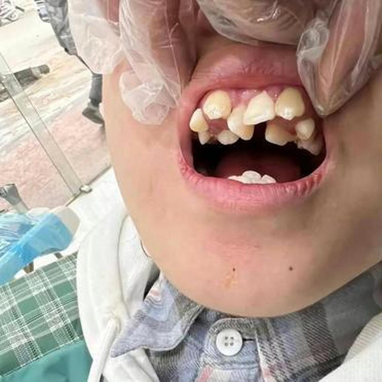 这牙要是被咬了一口,医生都不知道怎么缝吧