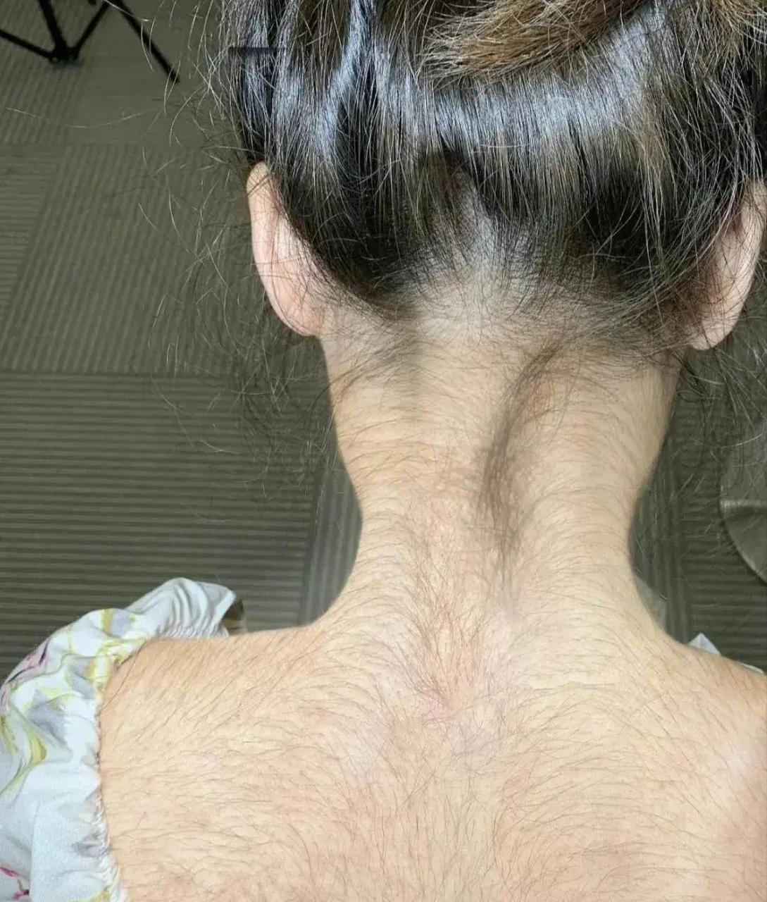 从青春期开始就汗毛旺盛,谈了三个男朋友都吓跑了,看了很多医院都没有