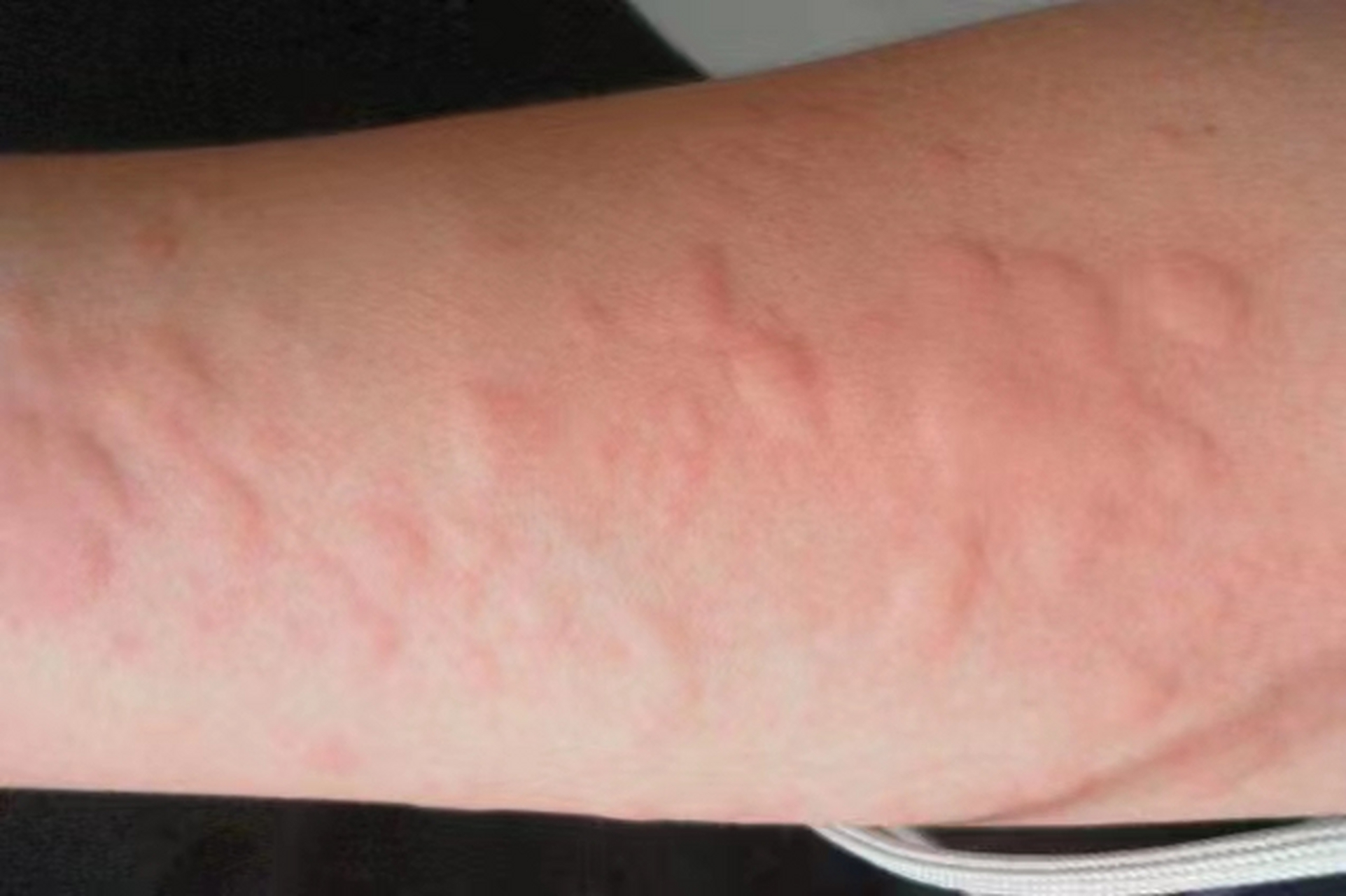 荨麻疹是过敏引起的水肿性团块,瘙痒,会自己消退,但反复复发,长时间