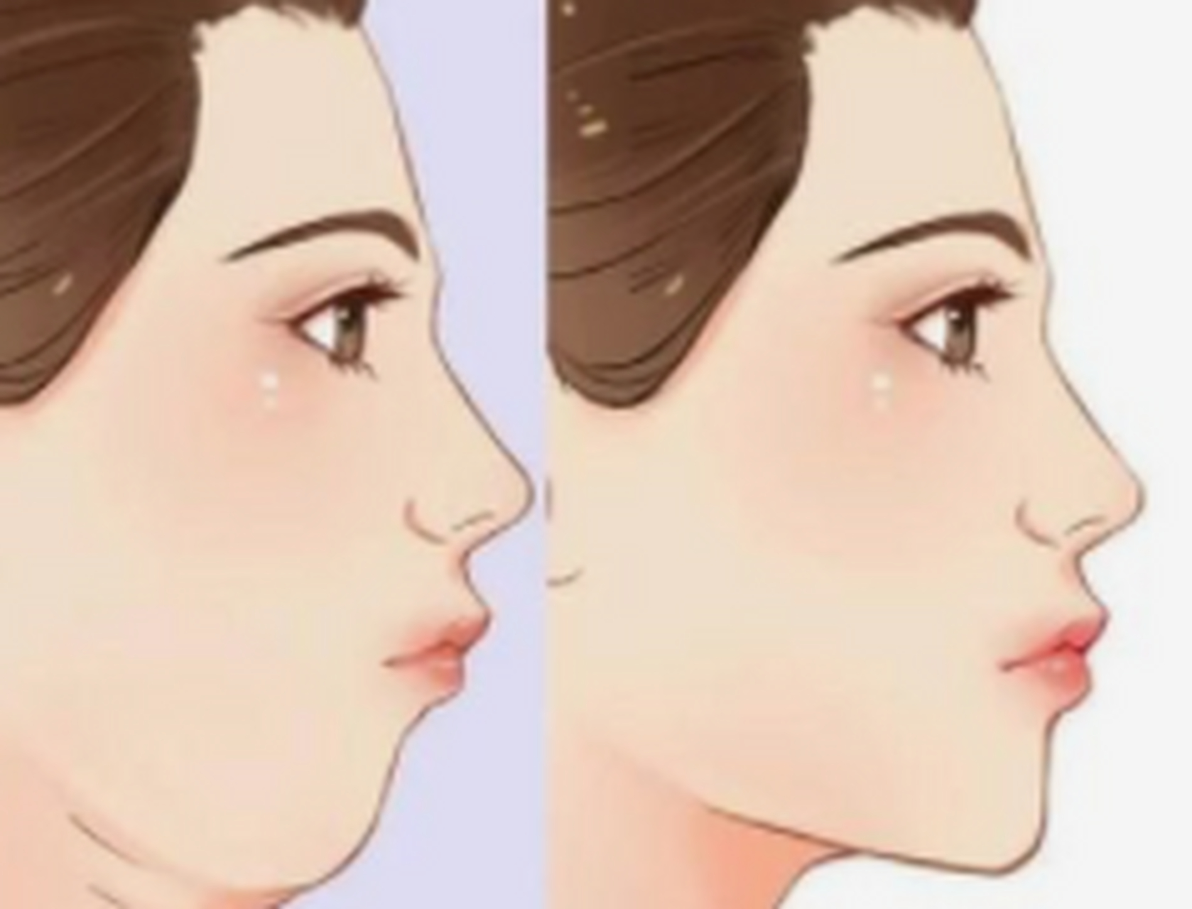 瘦脸针 下颌缘 提升针 又称少女线～随着年龄的增长颈阔肌的不断下拉