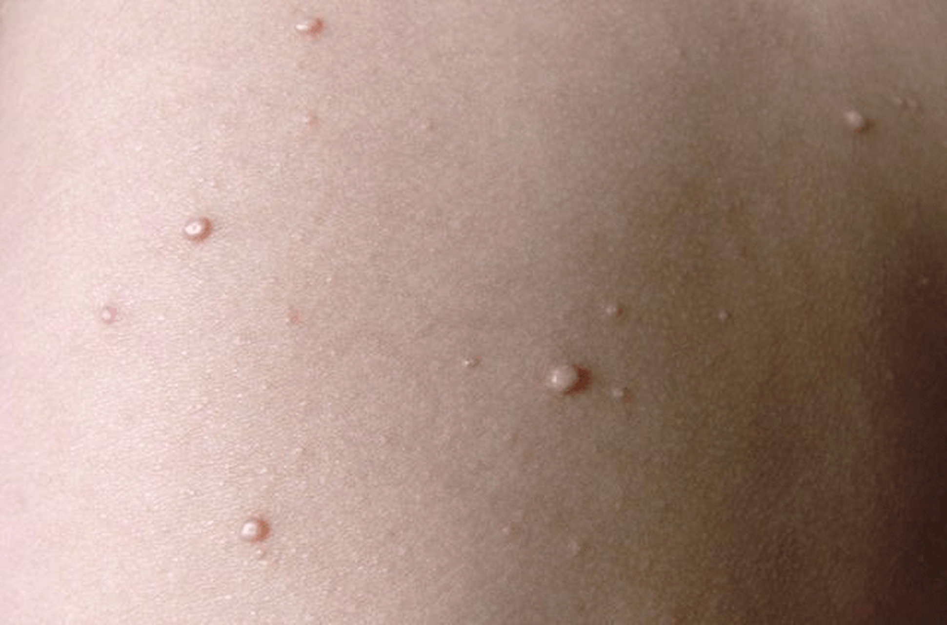 这里有疙瘩,就是感染hpv?
