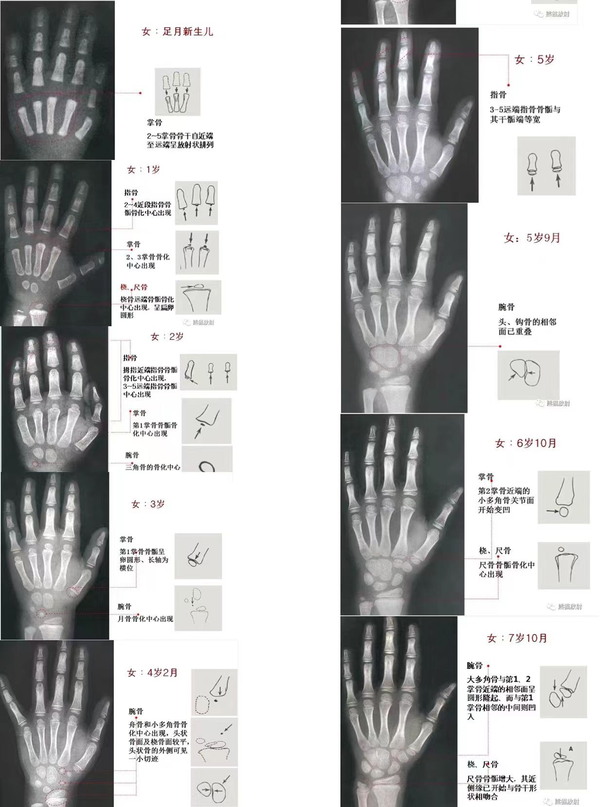骨龄偏大?怎么看骨龄图?