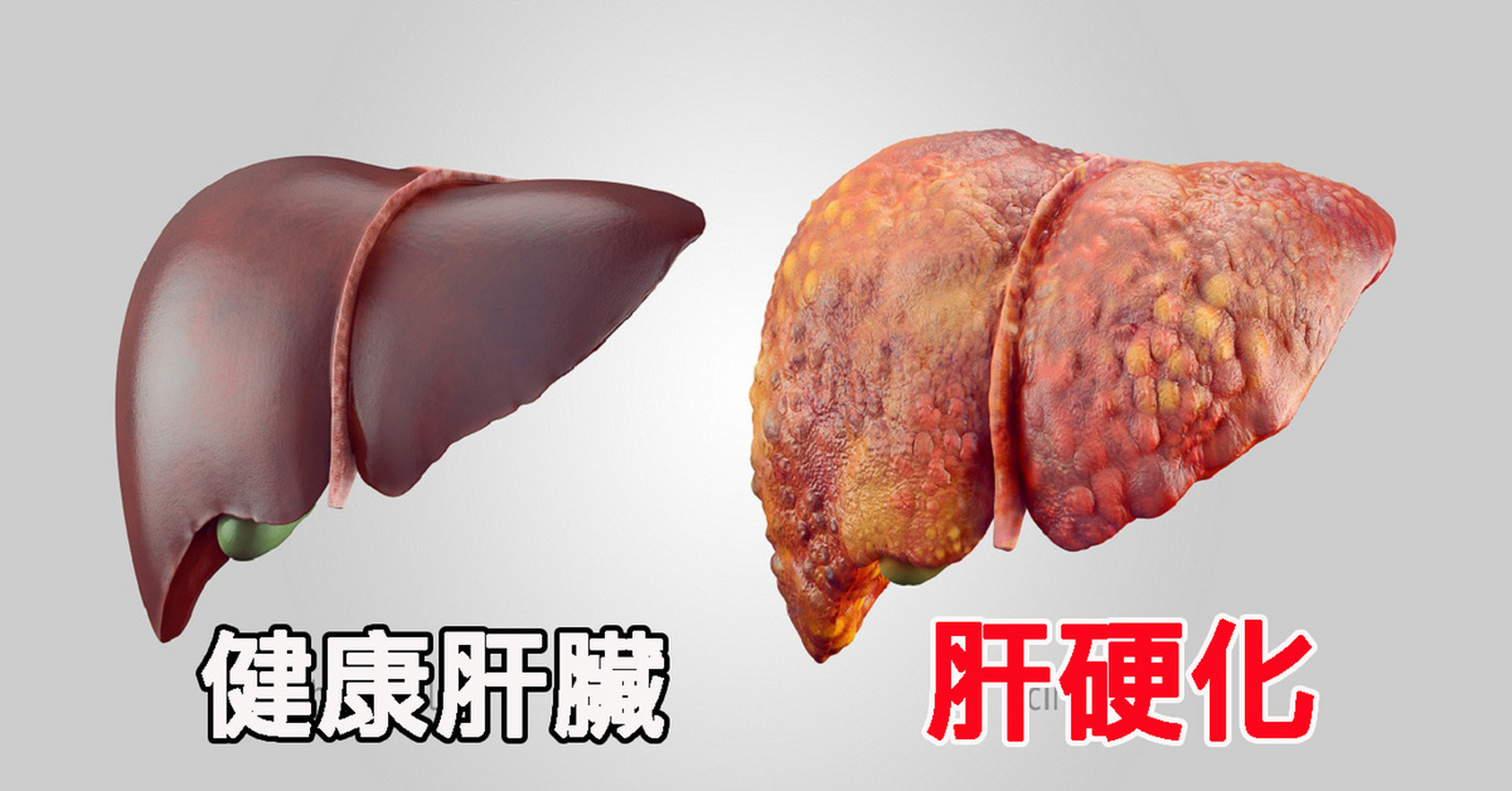 查出肝硬化别瞎治,否则越治越差!#肝病#   肝病科医生告诉您3句心里话