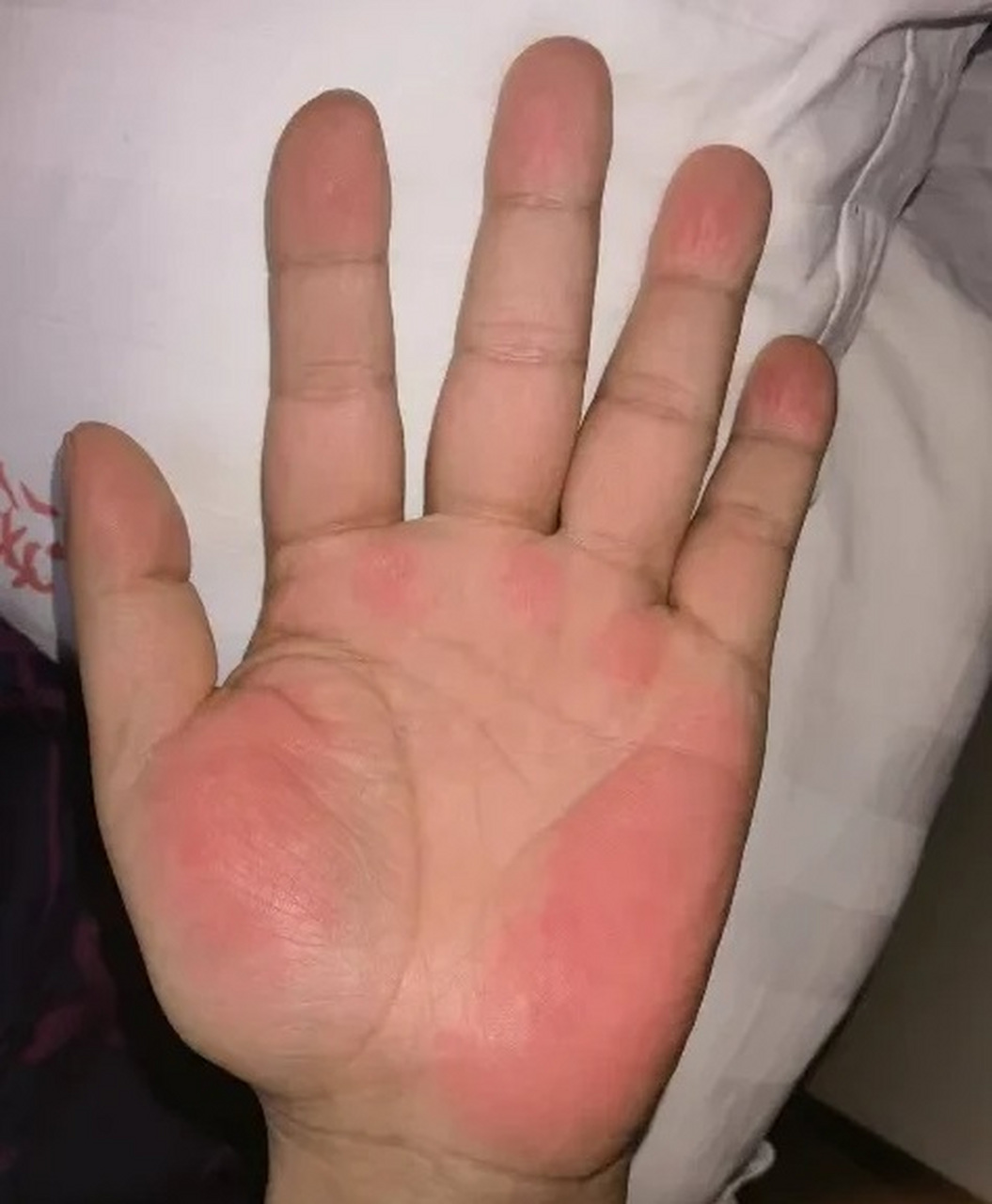 给大家看一个图片,图中这就是肝掌,很明显的就能看出,手掌的大小鱼际