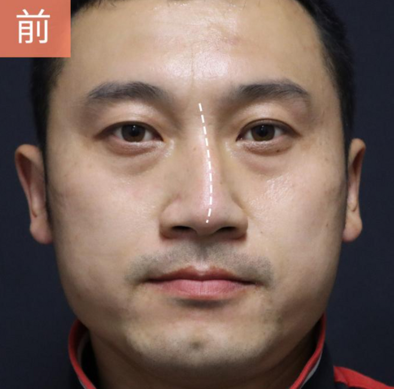 下面这位男患者,35岁,先天性歪鼻,术后做了鼻子矫正,通气都顺了呢.
