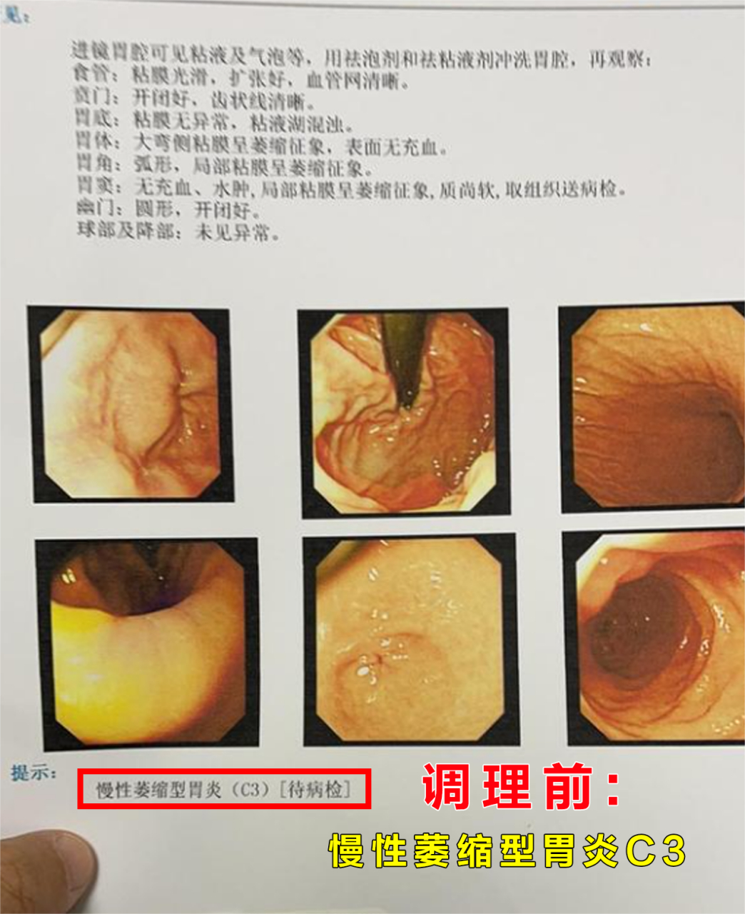 【逆转喜讯】患者52岁男性,诊断为慢性萎缩性胃炎c3型,患者有心慌胸闷