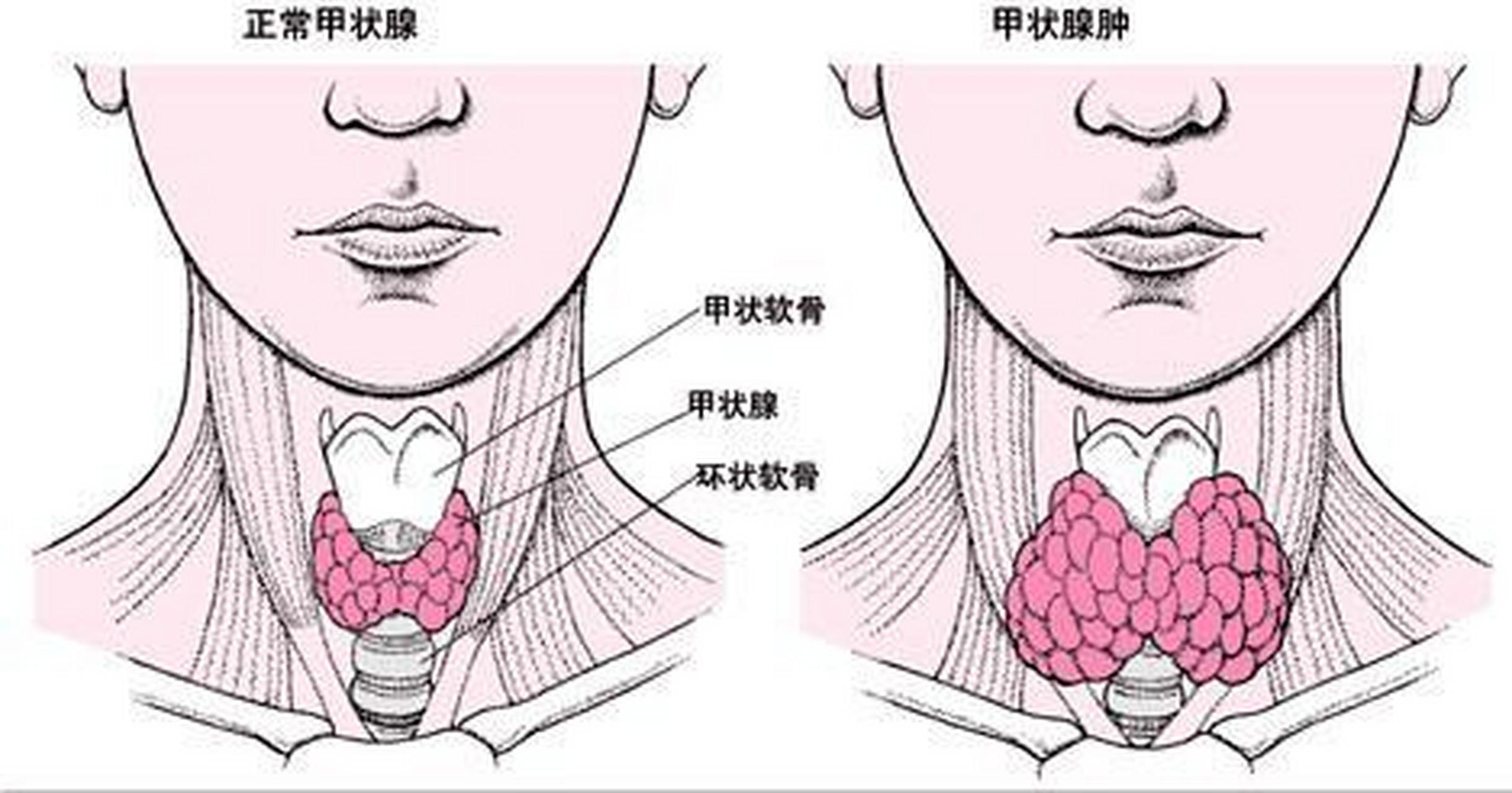 甲状腺结节在哪个位置图片