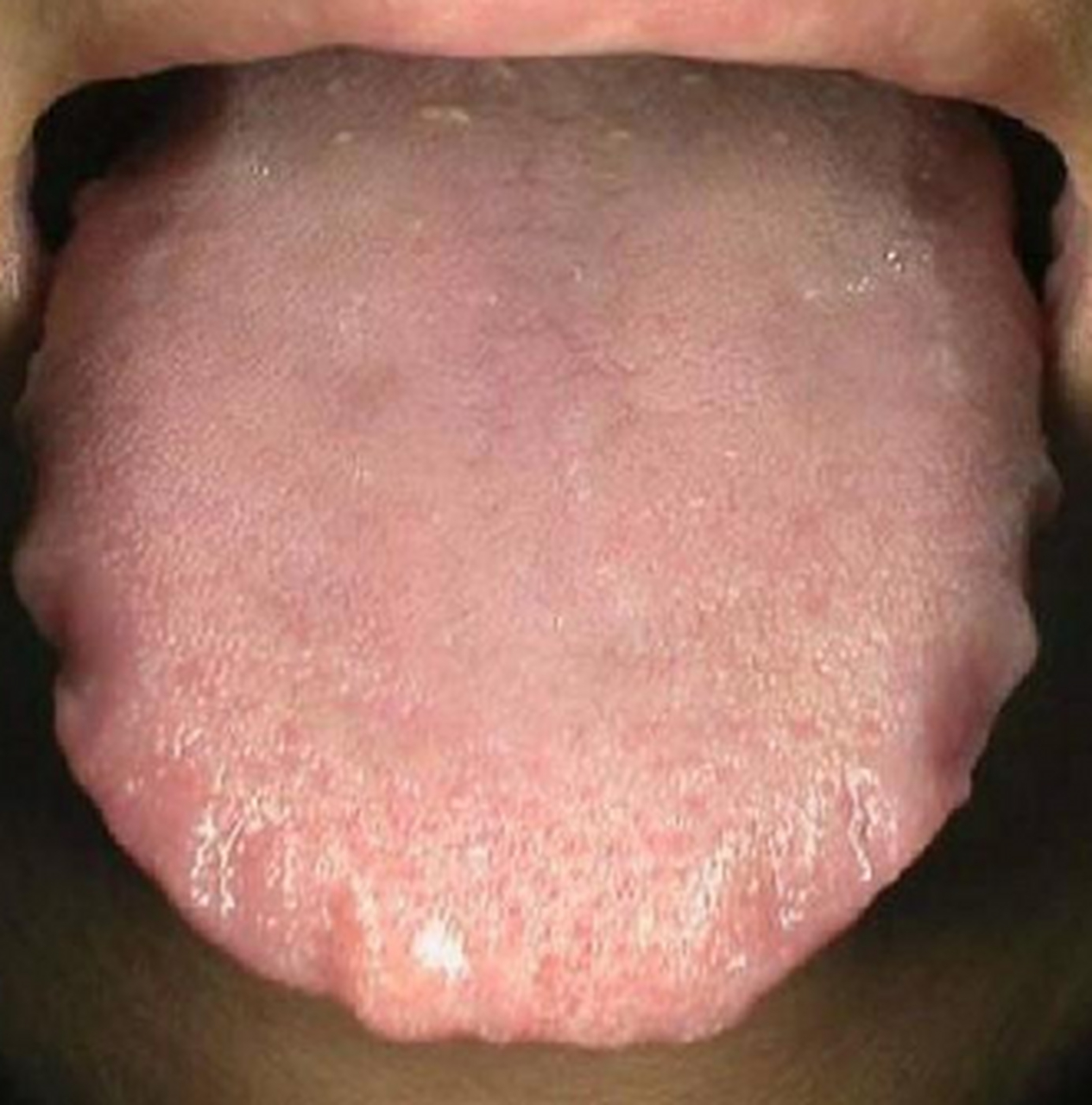 如果您的孩子舌头一伸出来,舌苔白,舌体胖大,舌头两边有齿痕,就是