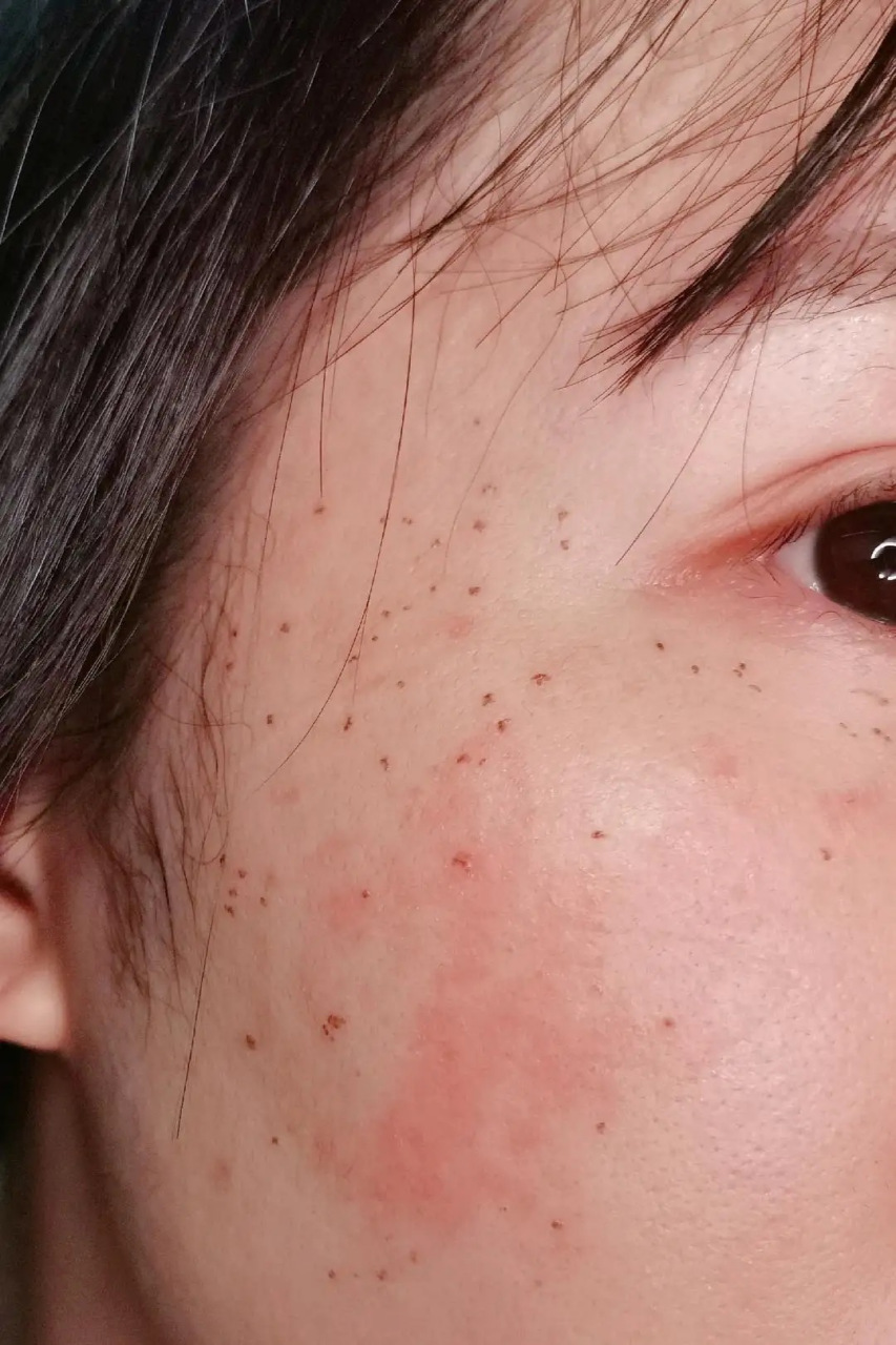 点痣多少钱一个?