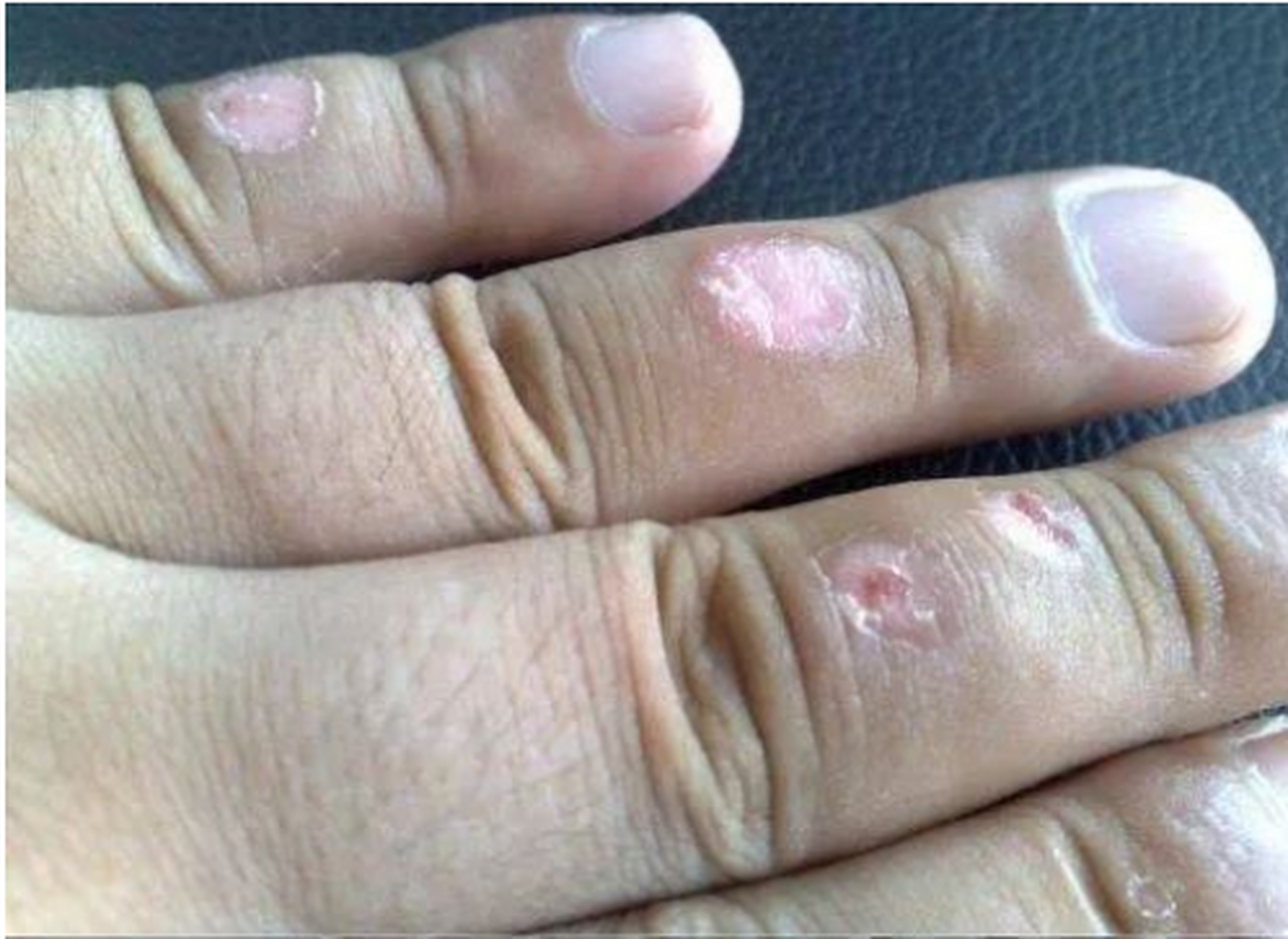 有粉丝询问:手指不小心受伤了,好了之后伤口周围出现了白斑,是