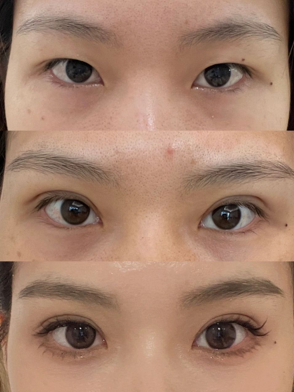 做了双眼皮以后真香  肿眼泡内双,全切去皮去脂7m  两个月以后化妆很