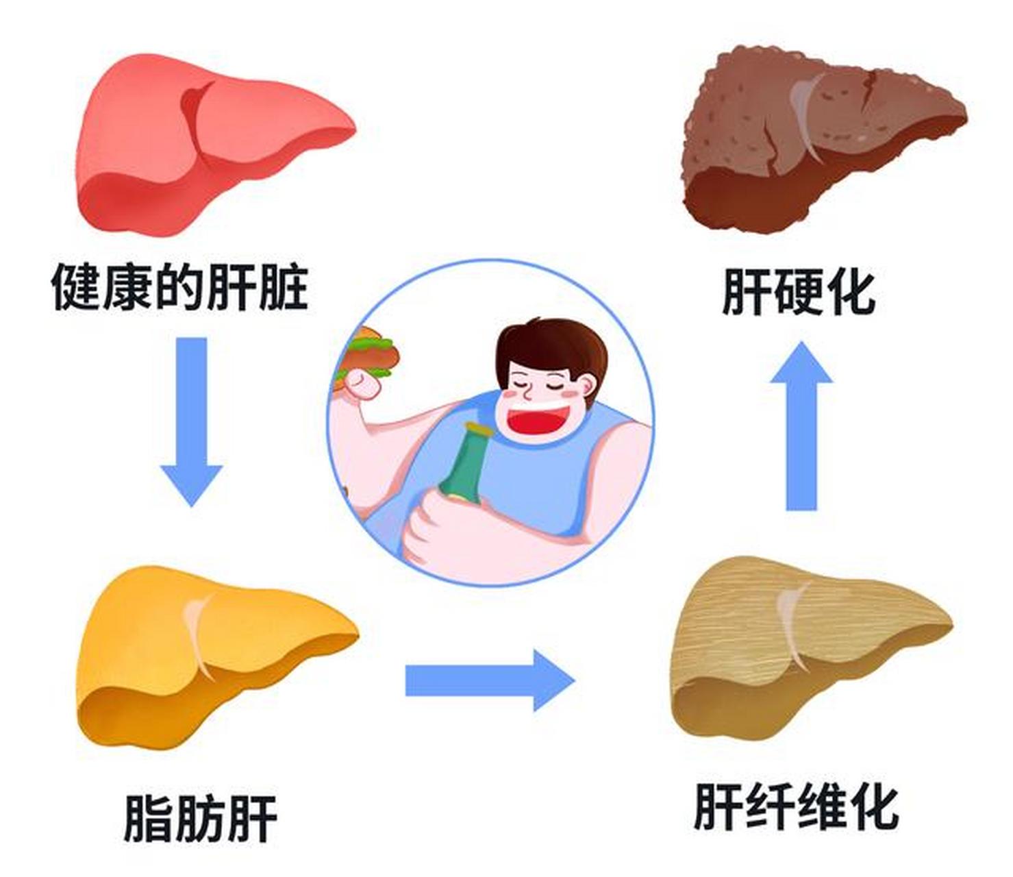 1. 食欲不振 食欲不振是脂肪肝最常见的症状之一. 2.