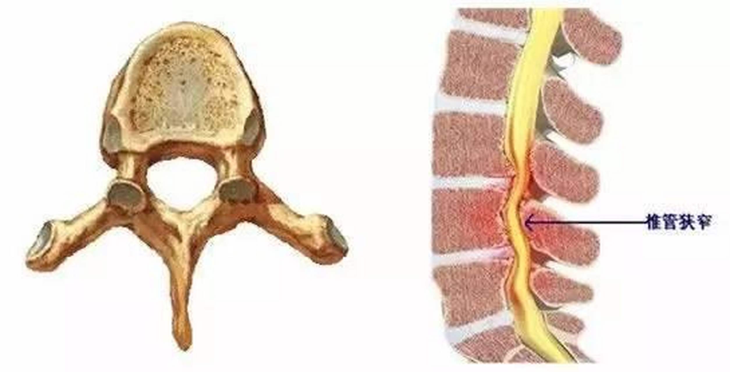 其实治疗腰椎管狭窄并没那么难,不用做手术也能好转,所以椎管狭窄的