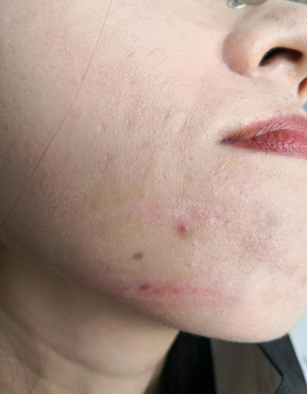 下面这位患者之前做光子嫩肤被烫伤后,看看做完修复后是怎么样的.