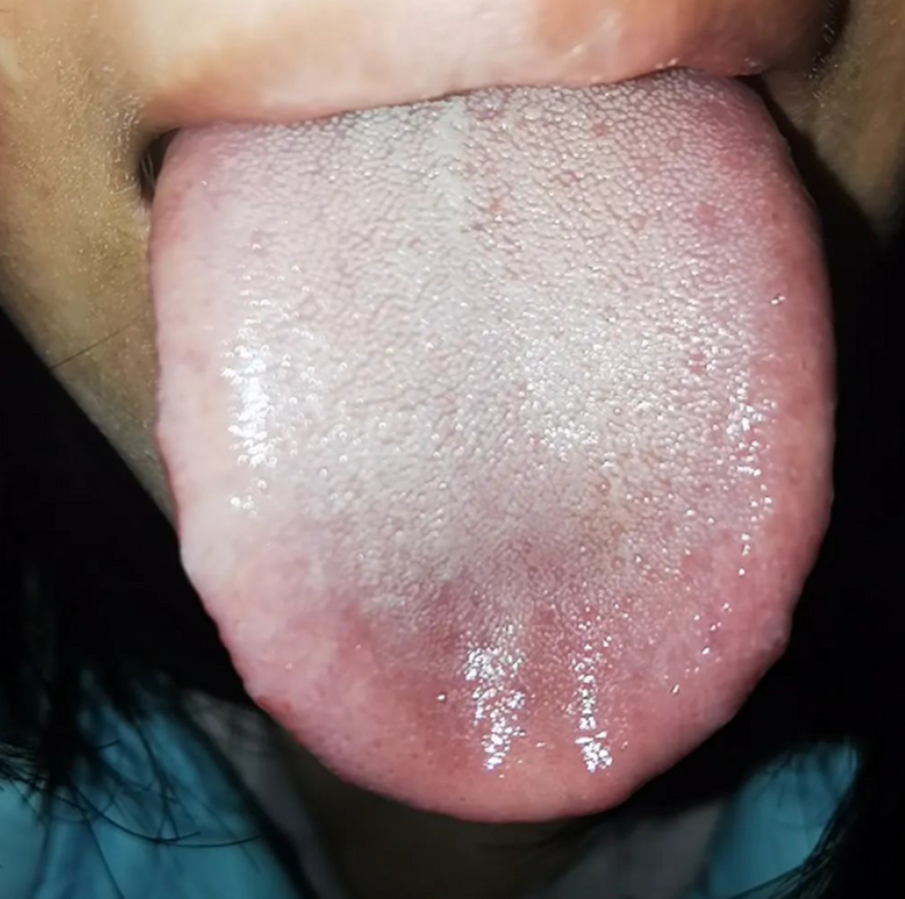 今天和大家分享一个小柴胡汤舌像  从方剂组成来说,柴胡,黄芩清热