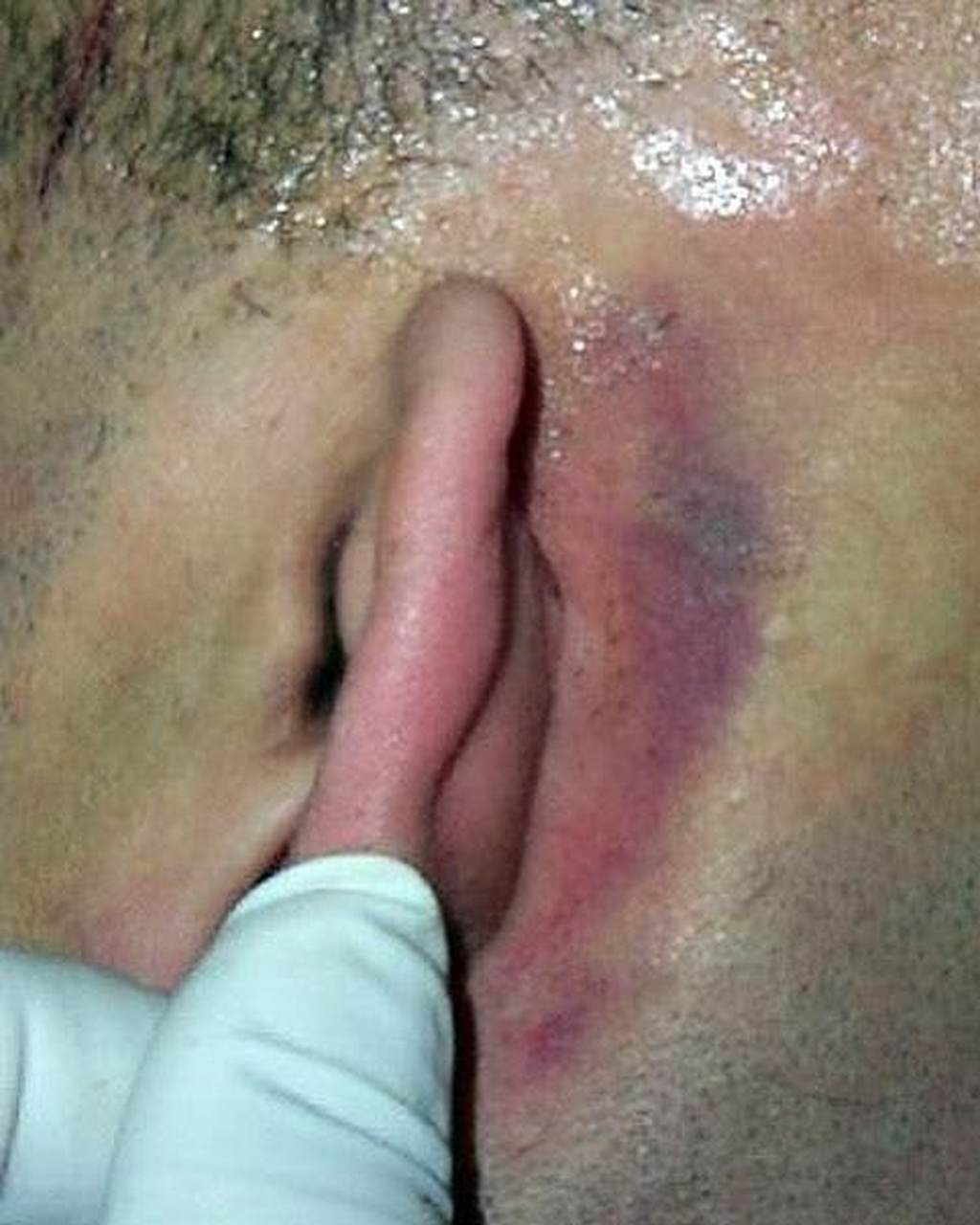 battle征,乳突瘀斑,为颅底骨折的一种体征.