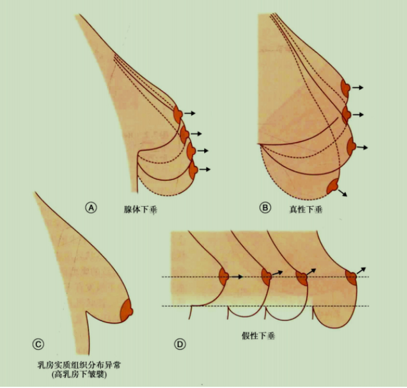 乳房位置低图片