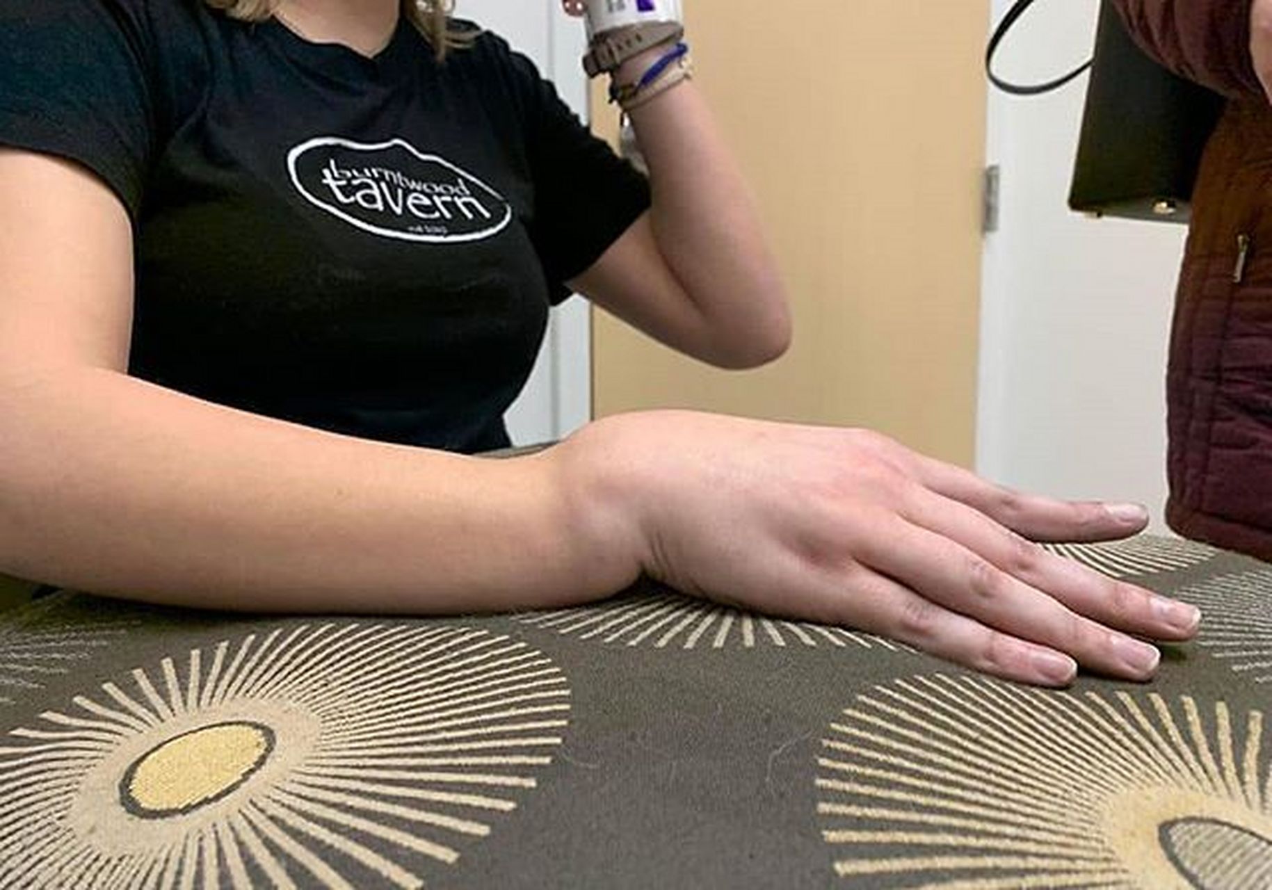 侧面看典型的"餐叉"畸形,即colles骨折,桡骨下端骨折的一种典型畸形.