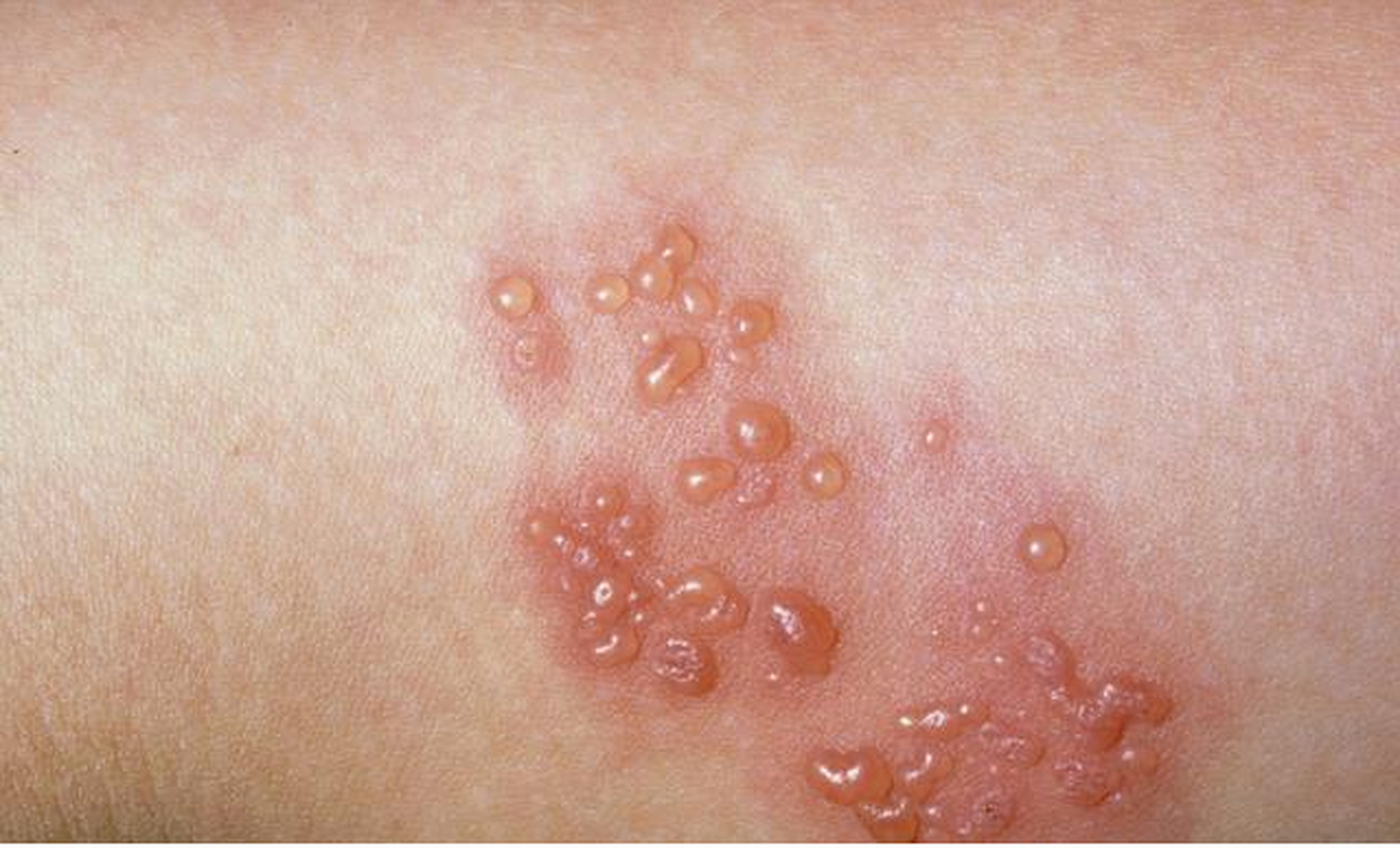 带状疱疹与水痘都是同一种病毒造成的,它就是水痘