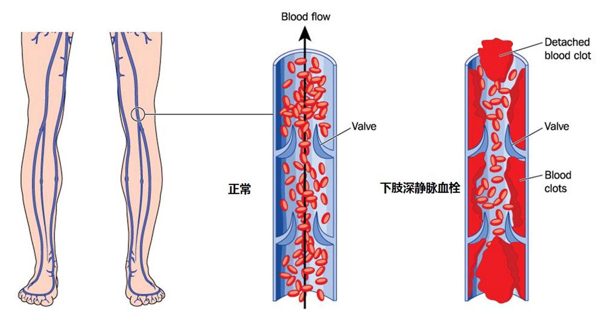 双下肢动脉硬化图片图片