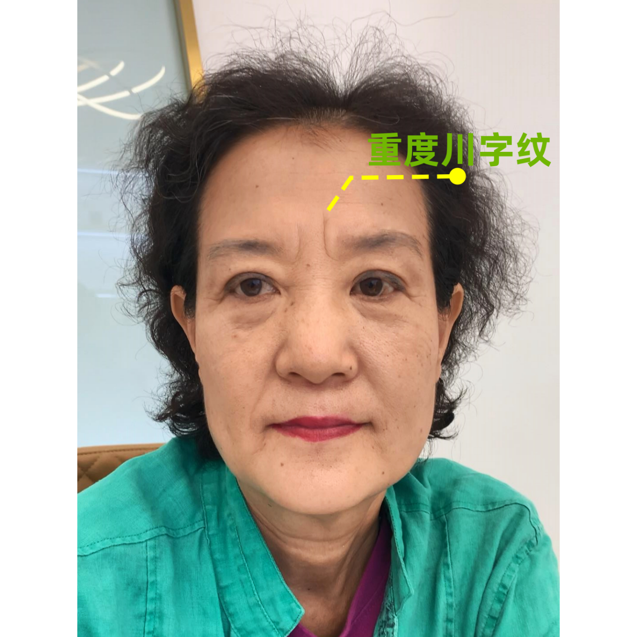 以相识人,在你身边有这样的人吗?印堂#川字纹# 嘴角下垂= 经常忧郁.