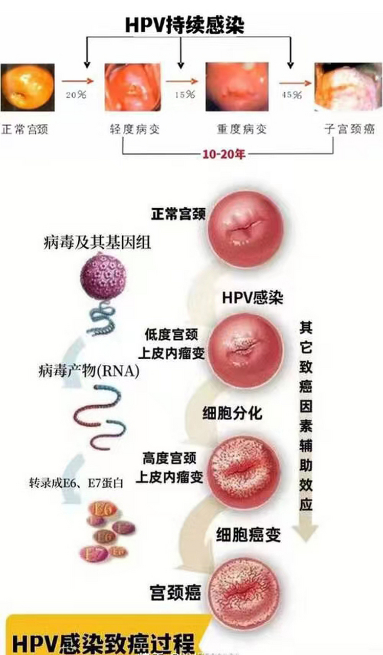 hpv感染女性症状图片