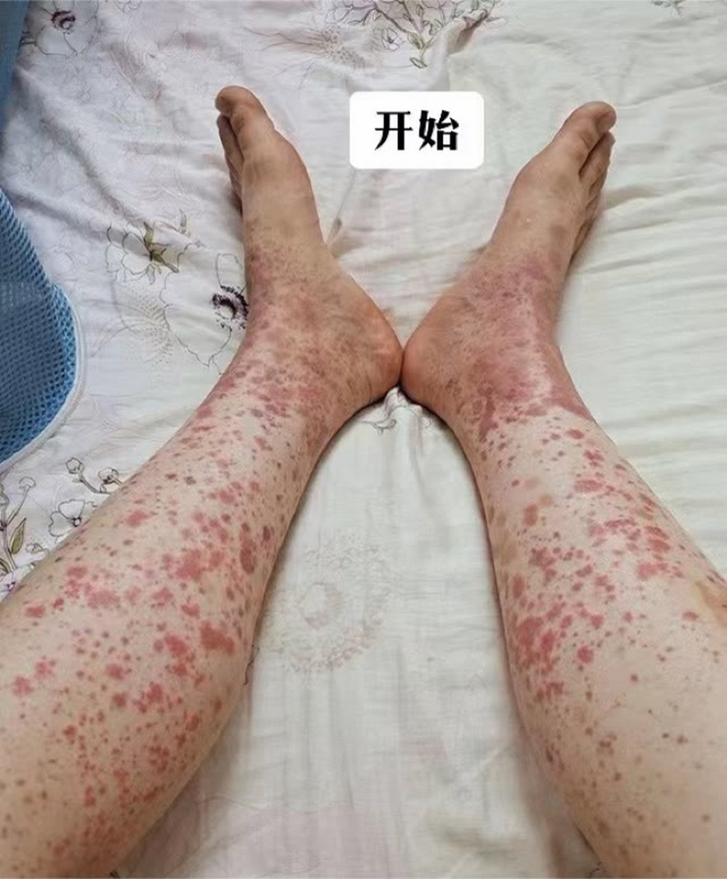 姑娘治疗前后三个月多,是皮疹型过敏性紫癜.
