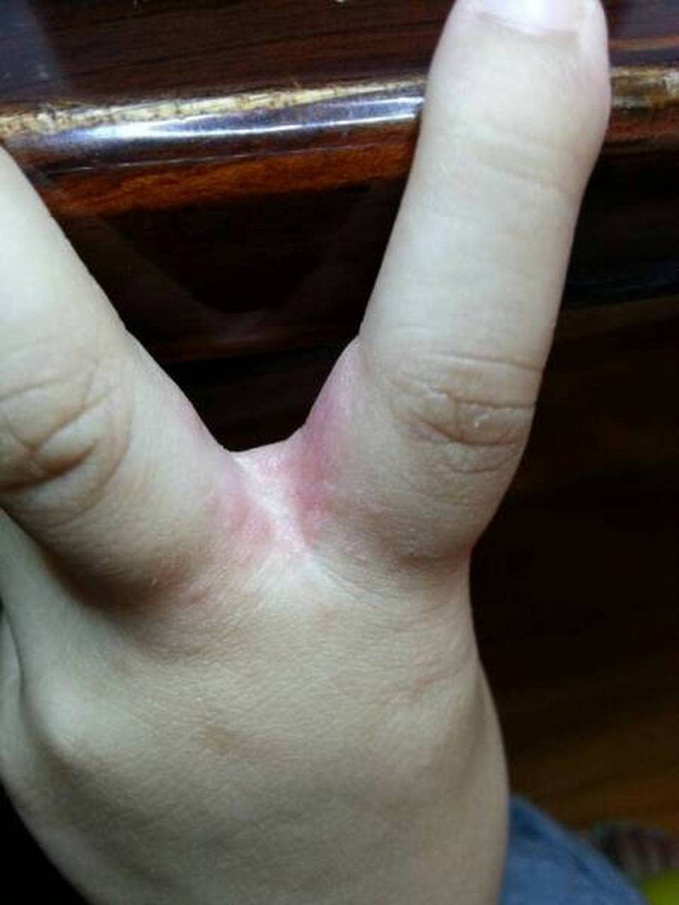 手指缝溃烂是什么病?什么原因引起的?
