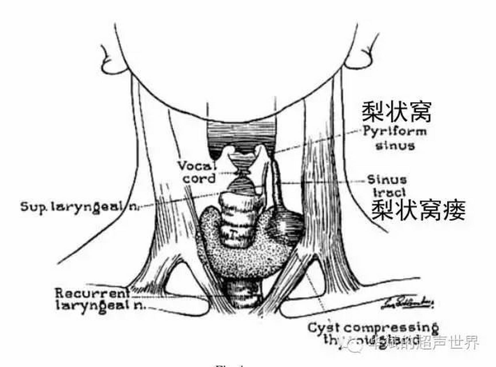 急性甲状腺炎:此炎非彼炎  急性,亚急性,慢性甲状腺炎,三者之间没有