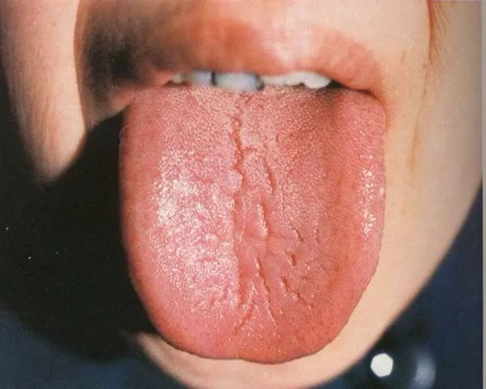 现在快拿出镜子来看一眼,裂纹舌的存在就意味着我们身体出现了问题