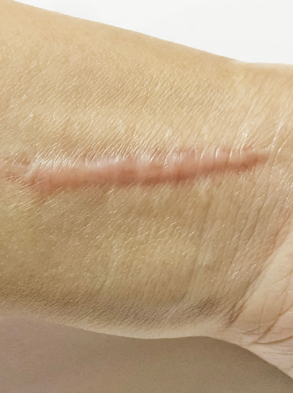 的皮肤问题,不少朋友都有这种疤痕的困扰,凸起的疤痕增生会由于创伤