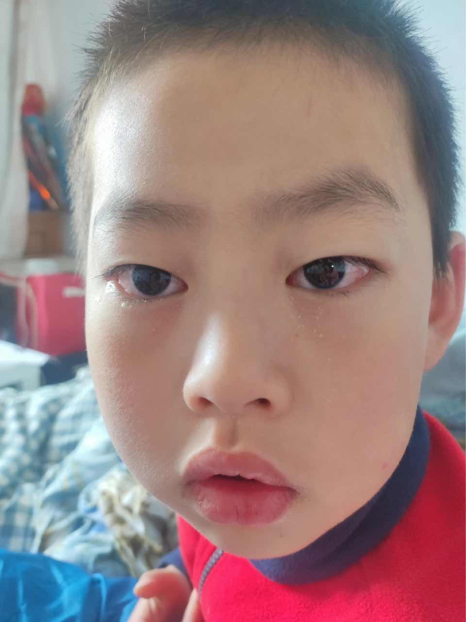 新冠二阳眼睛红98眼屎多结膜炎经验分享73  新冠新的病毒株04又