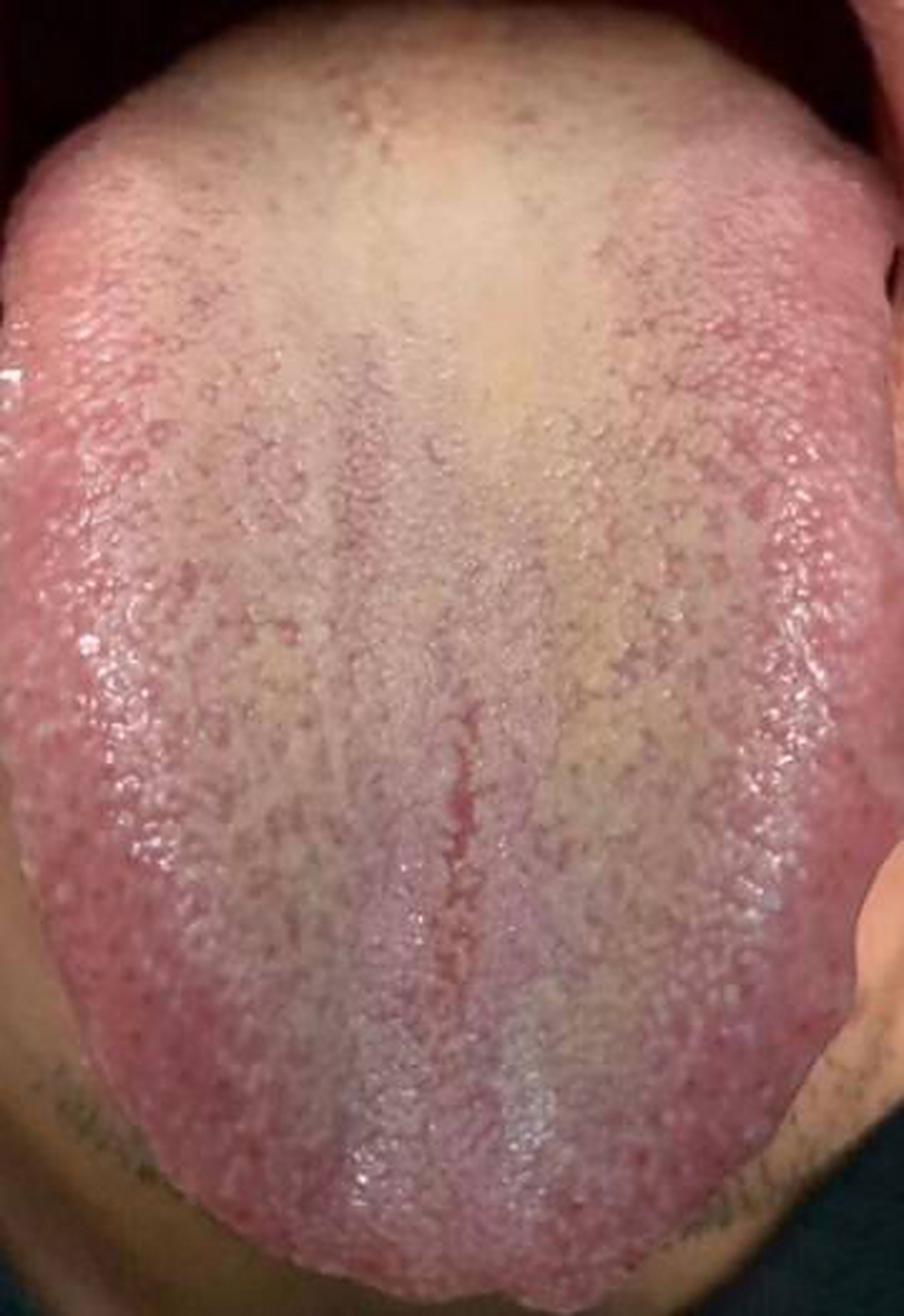 最近碰到好些个类似这种的裂纹舌,主什么呢?