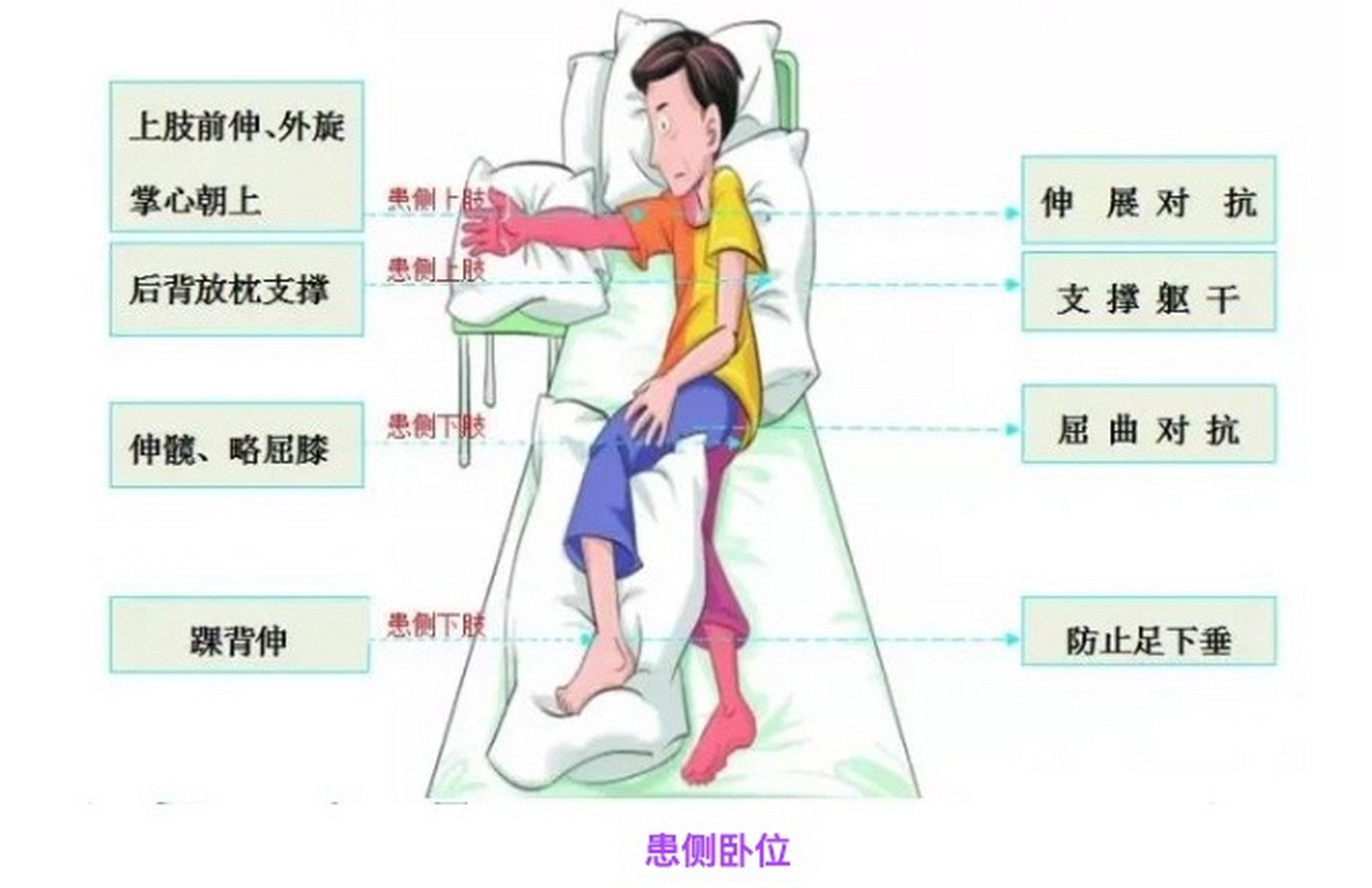 脑梗偏瘫后,良肢位摆放究竟怎么做才正确呢?