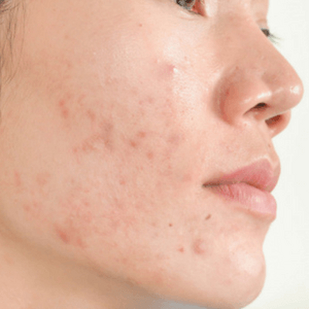 看看自己是否属于以下人群: ①皮糙肉厚,皮肤暗沉,毛孔粗大者; ②油性