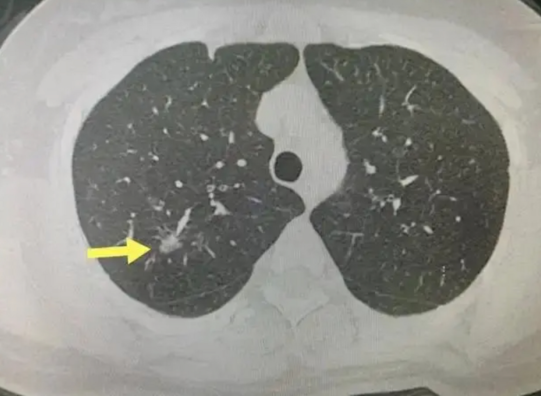 西醫認為肺結節8mm是明顯的手術指徵,可以做手術.