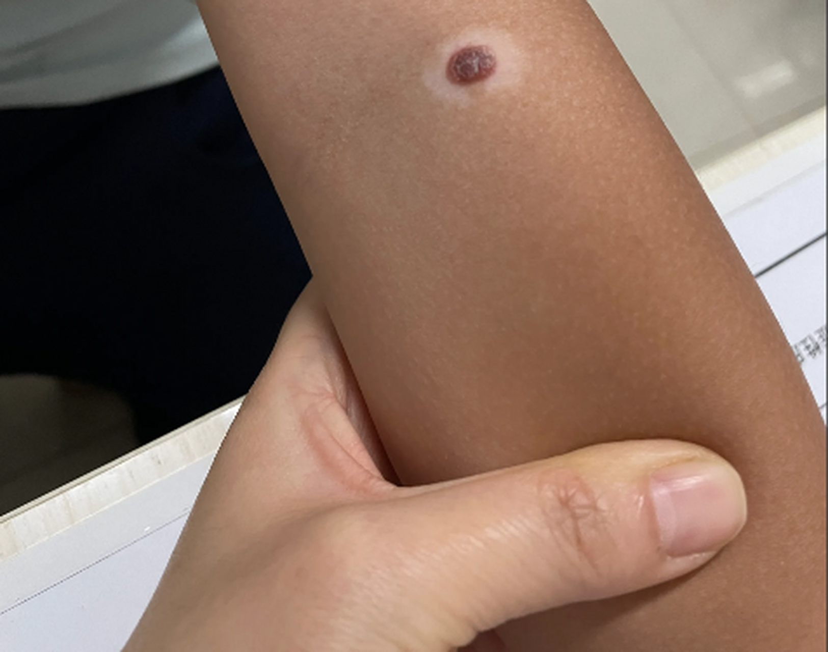 孩子一颗痣,周围变白了,经确诊为白癜风,    妈妈听到这个病后,很