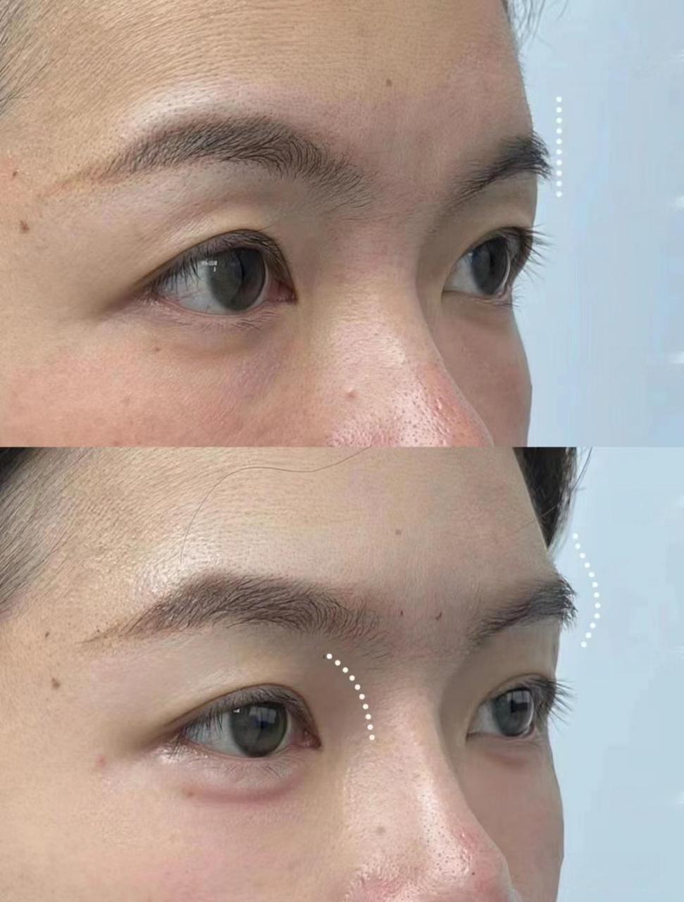 卧蚕 眉弓,改善不是一点点#玻尿酸丰卧蚕# #眉弓填充