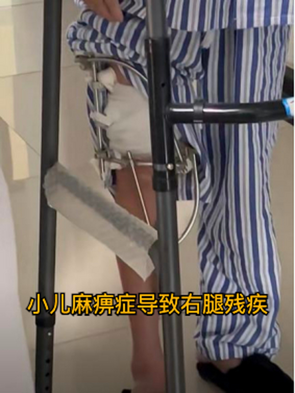 小儿麻痹症导致右腿残疾 我是一岁多的时候得的脊髓灰质炎 #脊髓灰质