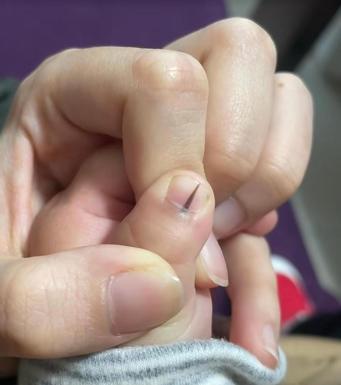 宝宝指甲里长出黑线越来越粗,这是啥啊 #娱乐