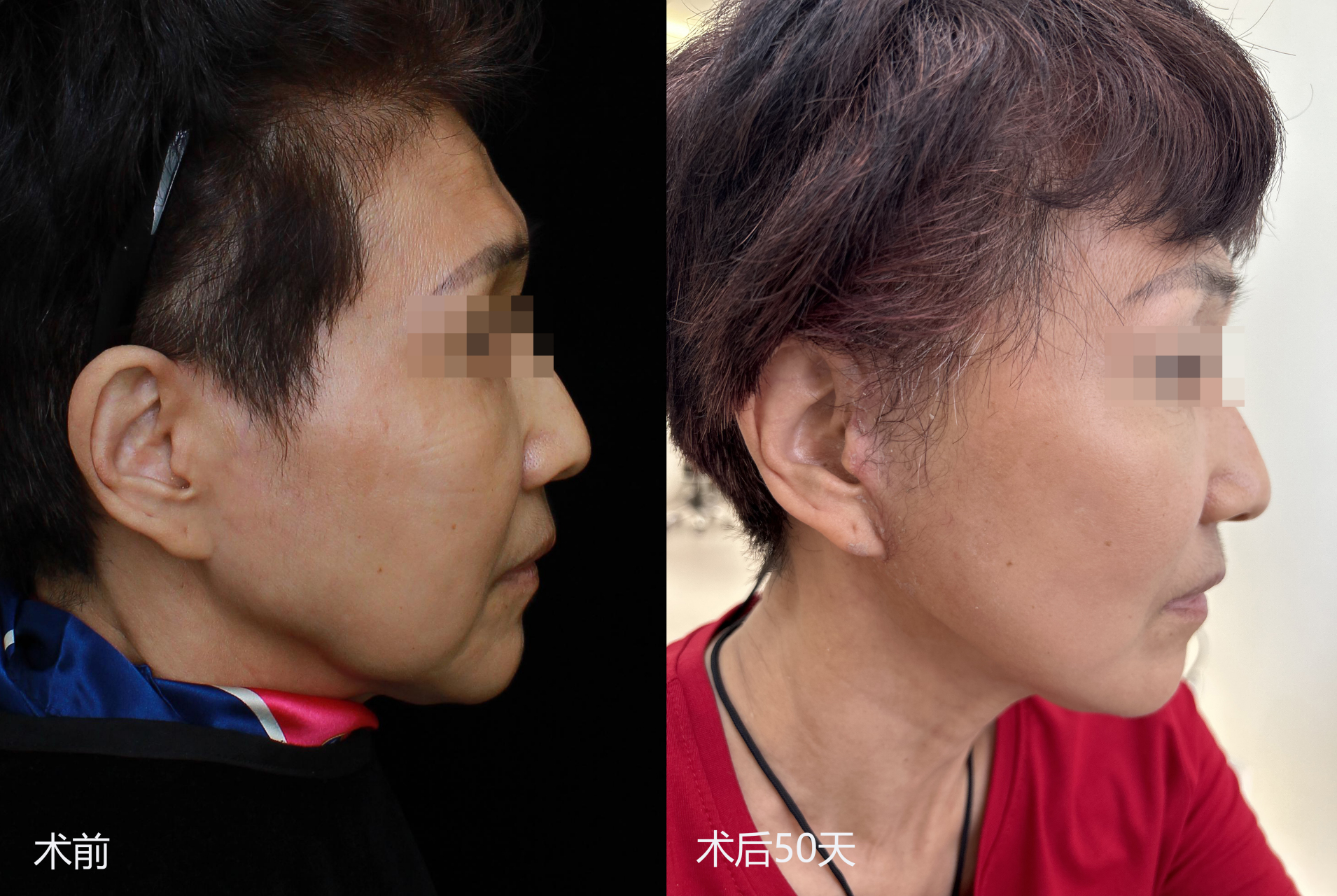 想做拉皮手术又担心没有效果?