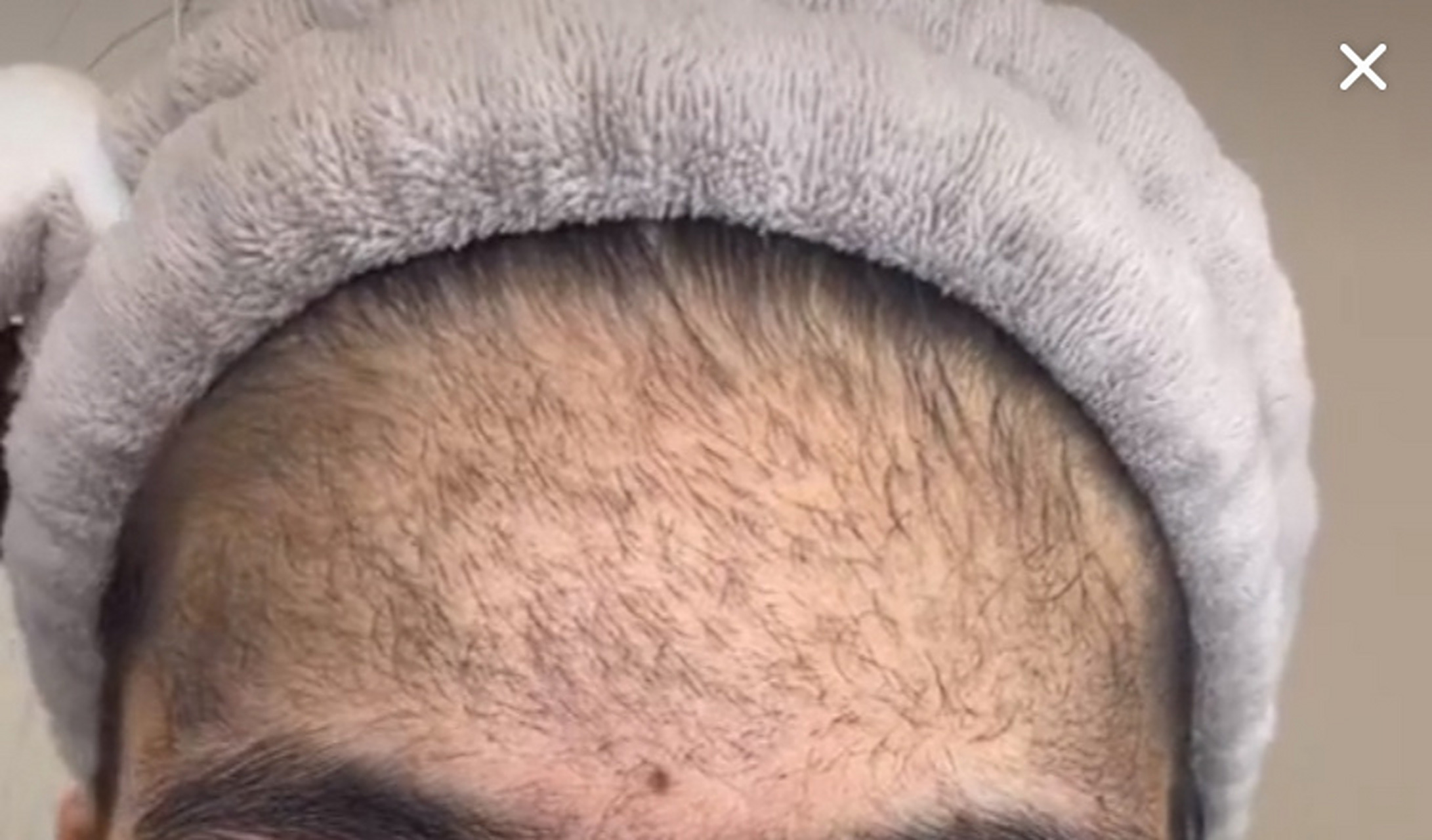 全脸长毛 额头上也长毛