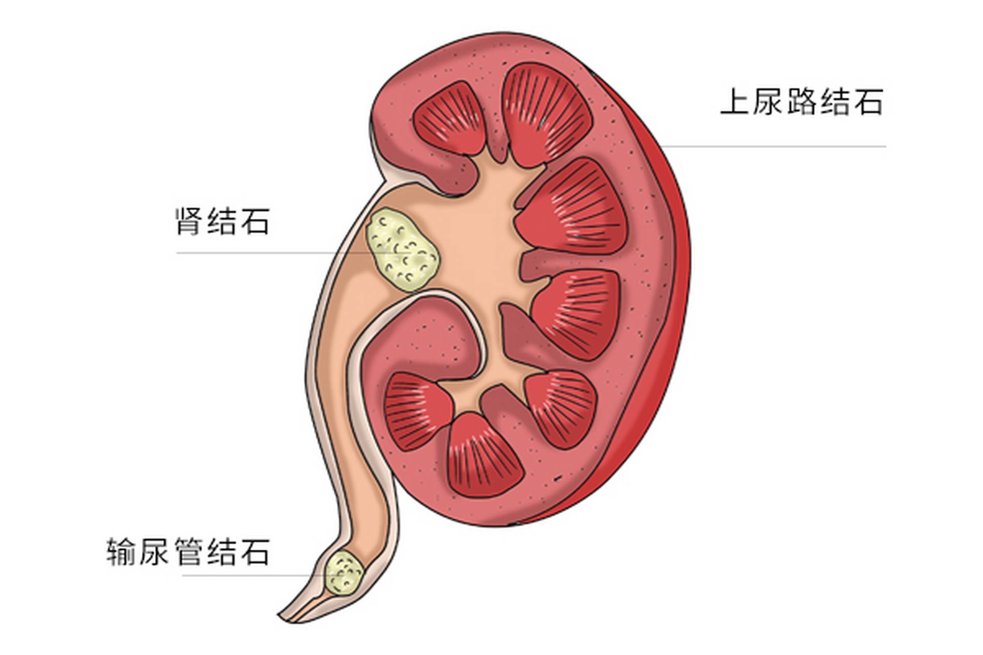 肾窦区结石图解图片