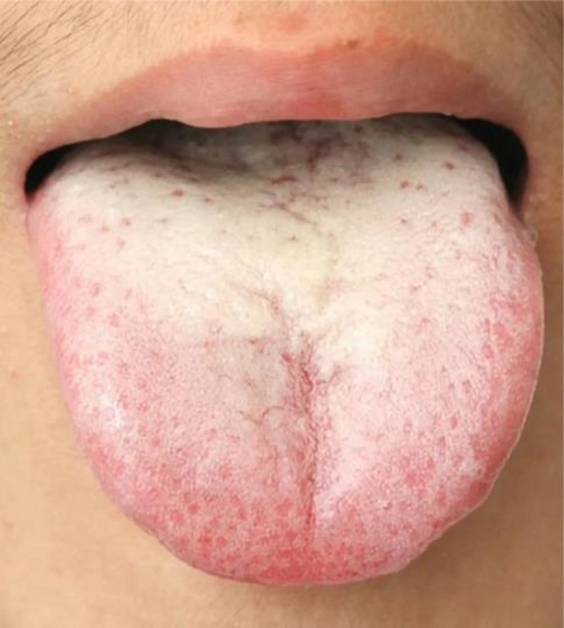 紫舌: 紫舌是血瘀证的重要表现之一,是诊断心血管