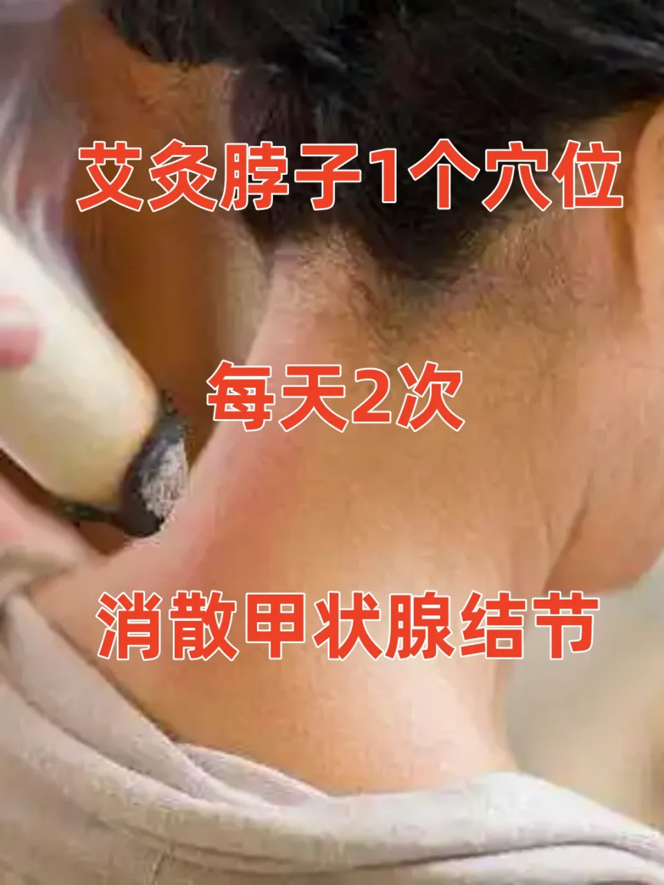 艾灸脖子1个穴位,每天2次,消散甲状腺结节